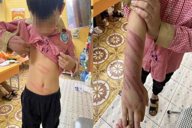 Xác minh vụ bé trai 8 tuổi bị người tình của mẹ bạo hành-1