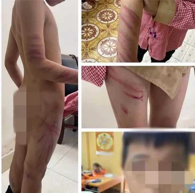 Bố dượng đánh bé trai 8 tuổi bầm dập: Dạy bảo chứ không ác ý-1