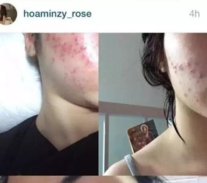 Mặt mộc Hòa Minzy thế nào sau nhiều lần toang nặng vì mụn?-3