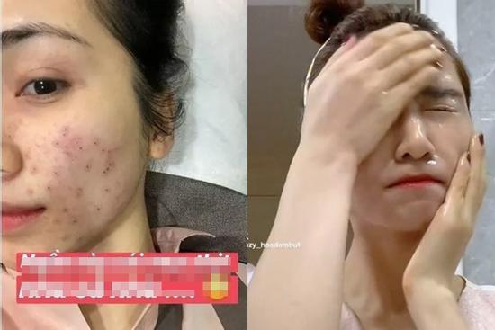 Mặt mộc Hòa Minzy thế nào sau nhiều lần toang nặng vì mụn?