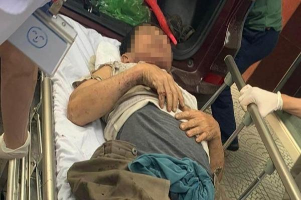 Kinh hoàng chủ doanh nghiệp bị dập nát chân do nổ thùng phuy-1