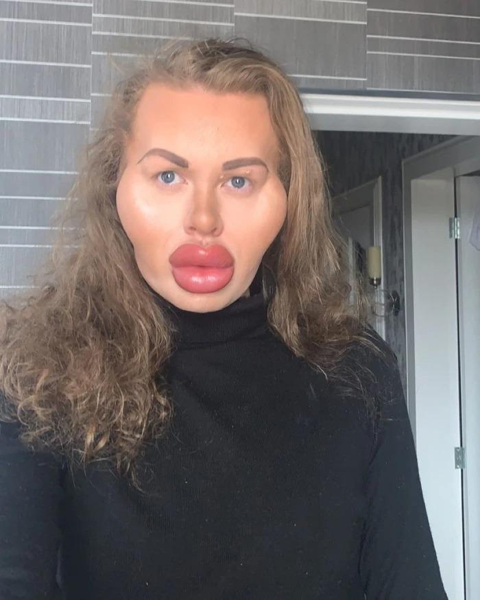 Người đàn ông nghiện tiêm filler đến mức mặt biến dạng-1