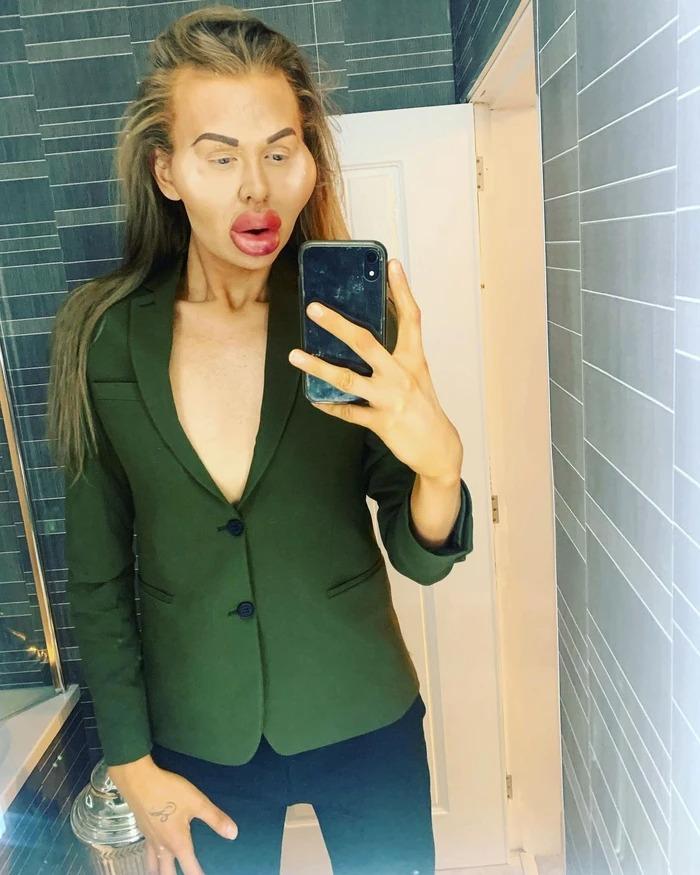 Người đàn ông nghiện tiêm filler đến mức mặt biến dạng-3