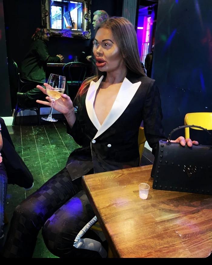 Người đàn ông nghiện tiêm filler đến mức mặt biến dạng-4