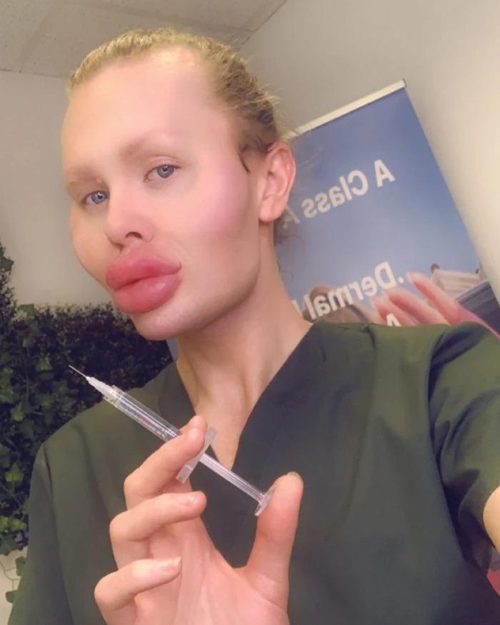 Người đàn ông nghiện tiêm filler đến mức mặt biến dạng-5