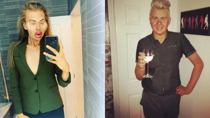 Người đàn ông nghiện tiêm filler đến mức mặt biến dạng-2