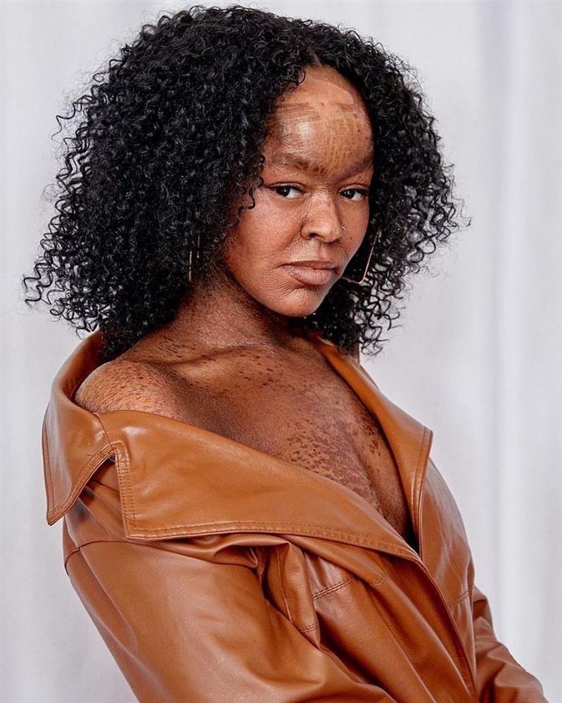 Người mẫu bị bệnh vảy cá làm thay đổi chuẩn mực vẻ đẹp-1