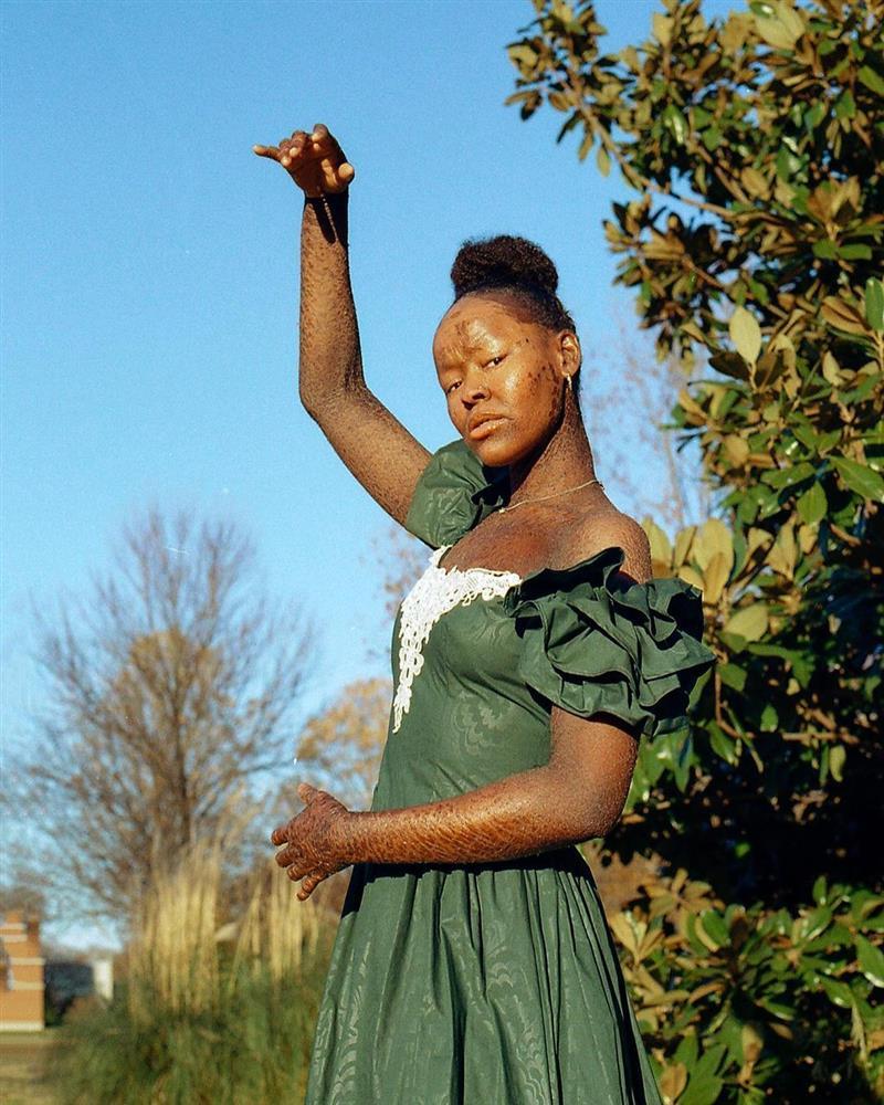 Người mẫu bị bệnh vảy cá làm thay đổi chuẩn mực vẻ đẹp-3