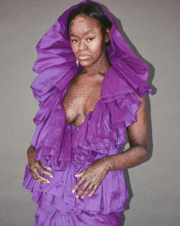 Người mẫu bị bệnh vảy cá làm thay đổi chuẩn mực vẻ đẹp-6