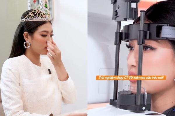 Sống mũi phát sáng liệu có phải bằng chứng dao kéo khó chối cãi?-8