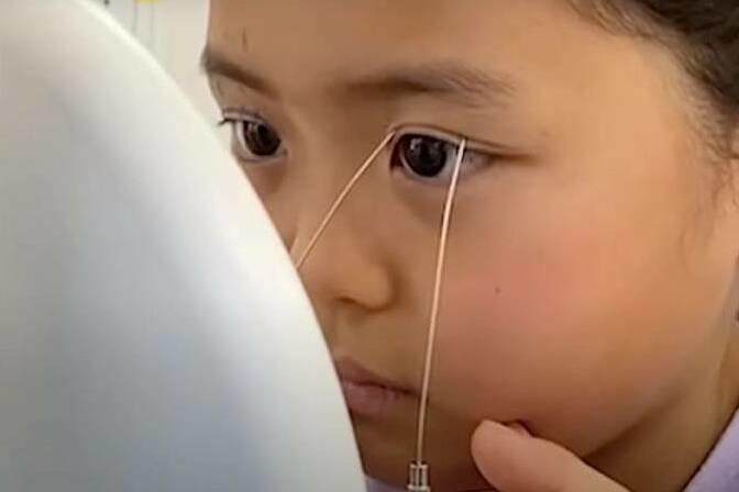 Bé gái 9 tuổi được mẹ đưa đi cắt mí-2