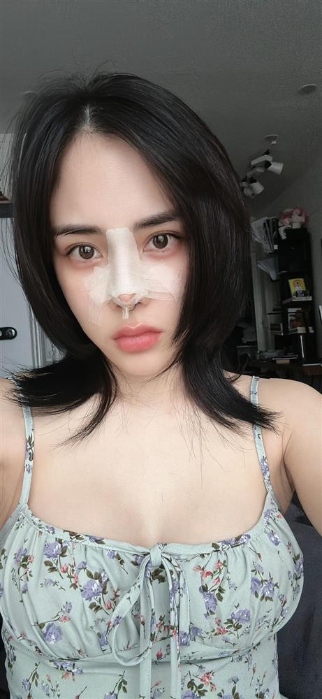 Bạn gái Huỳnh Anh phẫu thuật hạ sống mũi, hé lộ lý do-1