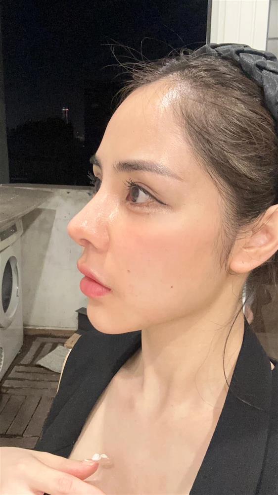 Bạn gái Huỳnh Anh phẫu thuật hạ sống mũi, hé lộ lý do-2