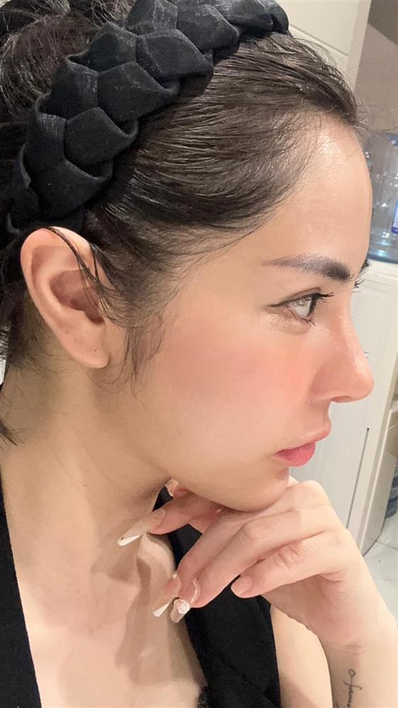 Bạn gái Huỳnh Anh phẫu thuật hạ sống mũi, hé lộ lý do-3