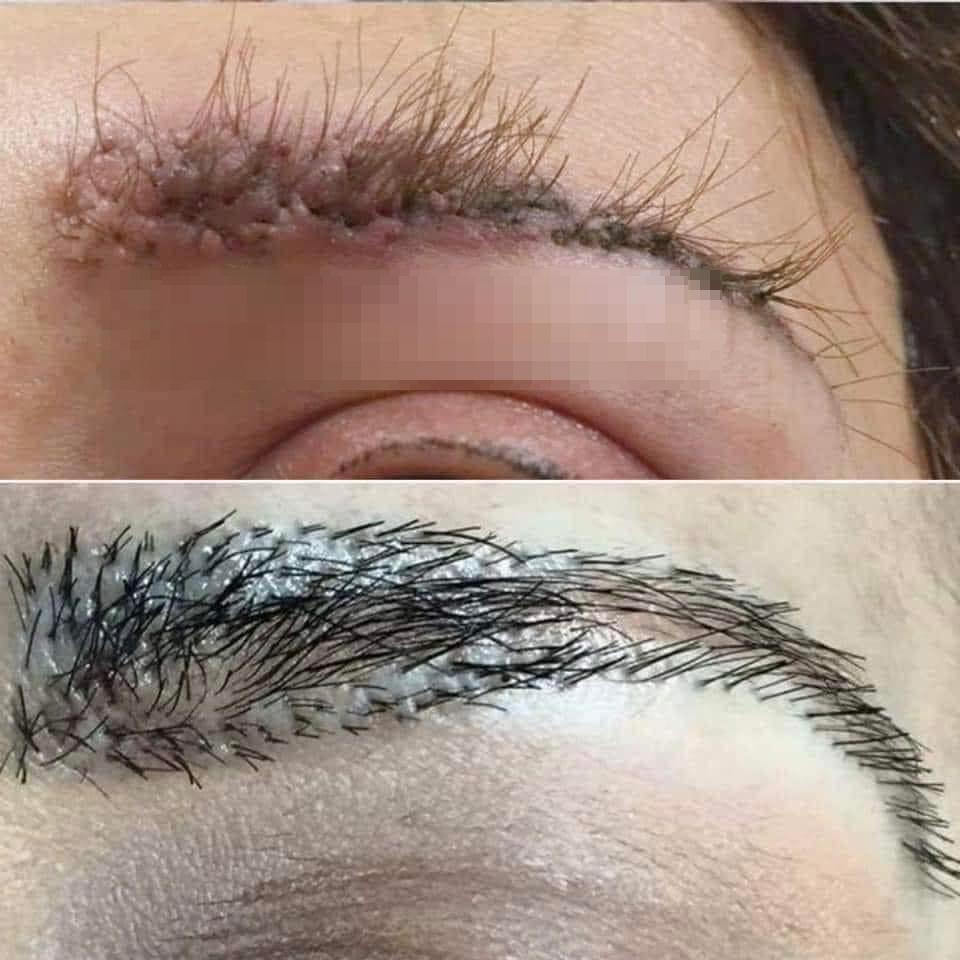 Cấy lông mày chanh sả, người phụ nữ nhận thành quả đớn đau-1