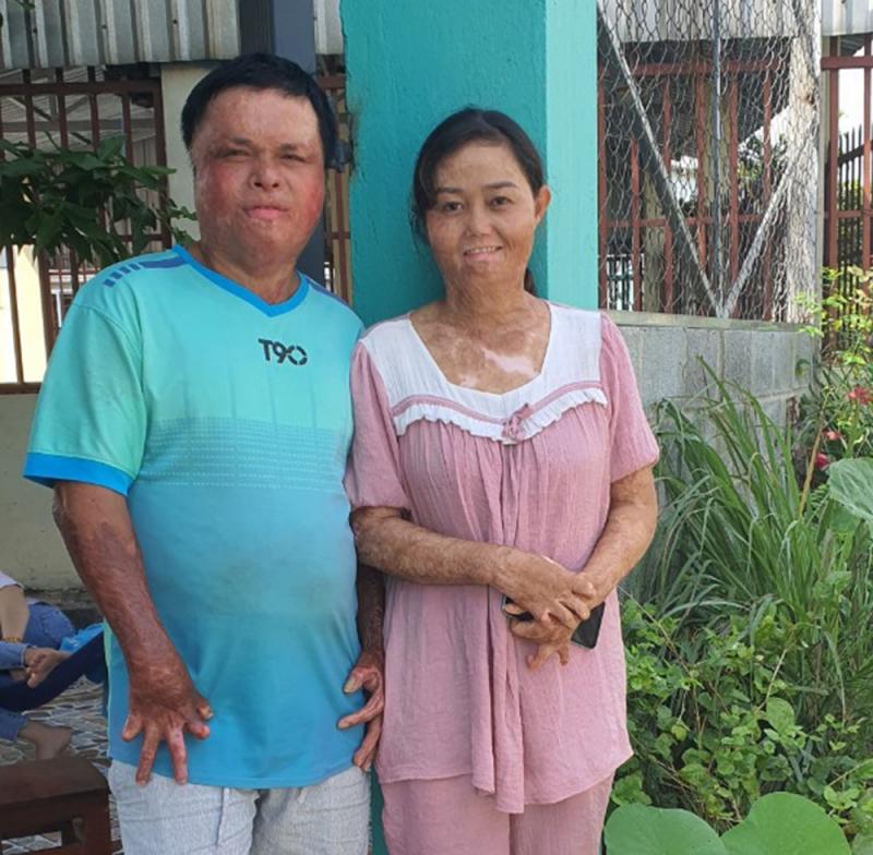 Hạnh phúc ngọt ngào của người phụ nữ từng bị thiêu sống-2