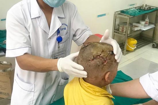 Bé 2 tuổi bị chó cắn nát vùng mặt, hở cả xương sọ