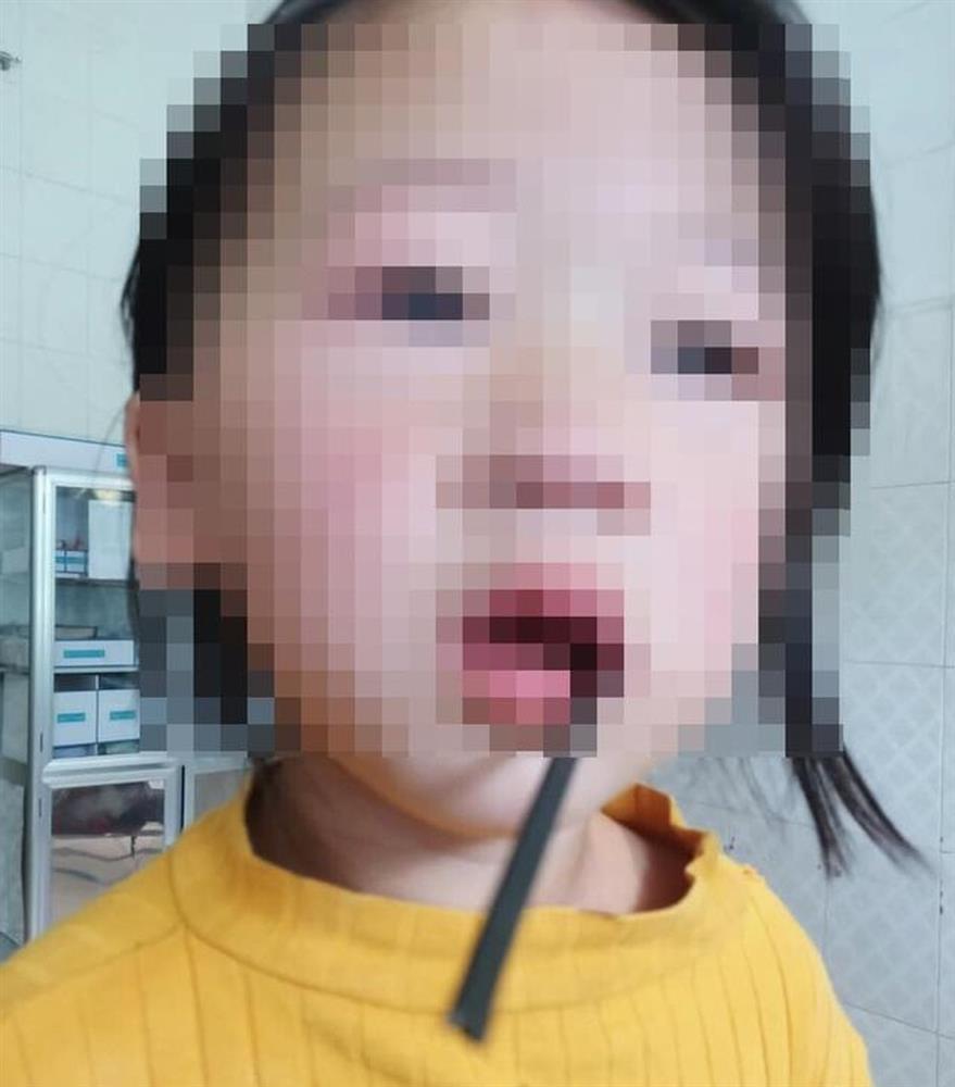 Hãi hùng bé gái 4 tuổi bị thanh sắt đâm xuyên miệng-1