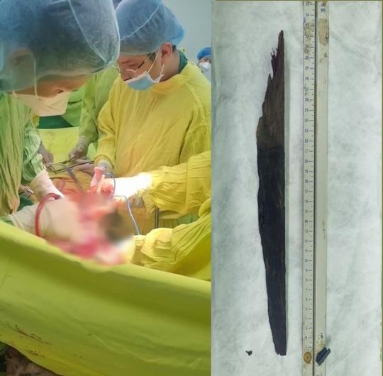 Tránh chó, rơi xuống sông bị thanh gỗ đâm xuyên phổi, thấu gan-1