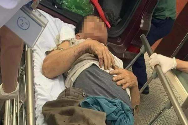 Cụ ông suýt chết vì điện thoại bất ngờ phát nổ và cháy dữ dội trong túi áo-1