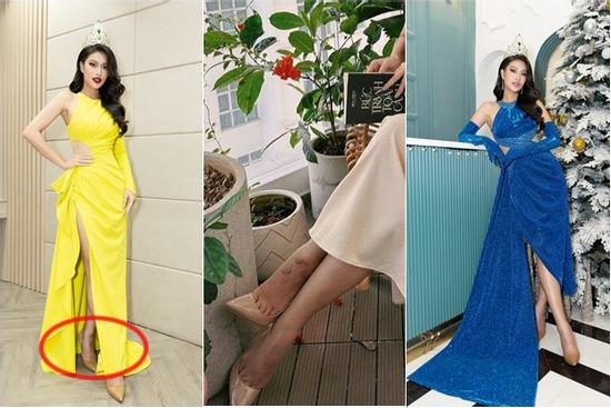 Hoa hậu Thiên Ân quên photoshop vết sẹo lồi thâm đen