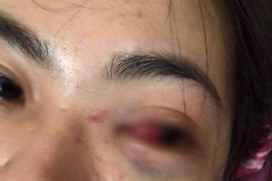 Nữ sinh lớp 11 bị nhóm bạn đánh tụ máu mắt