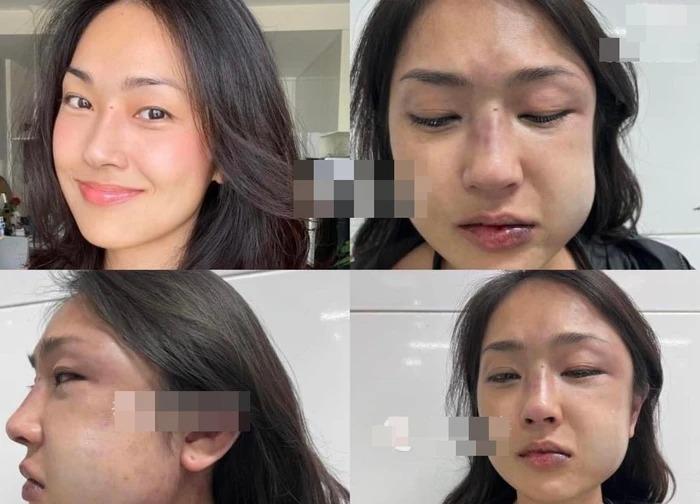 MC Misoa nghi bạn trai lăng nhăng liền bị đánh sưng mặt-1