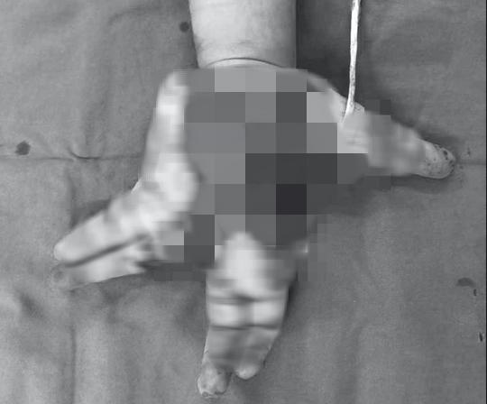 Nổ điện thoại, thiếu niên 14 tuổi bị biến dạng bàn tay-1