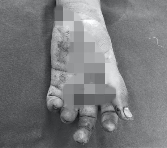 Nổ điện thoại, thiếu niên 14 tuổi bị biến dạng bàn tay-2