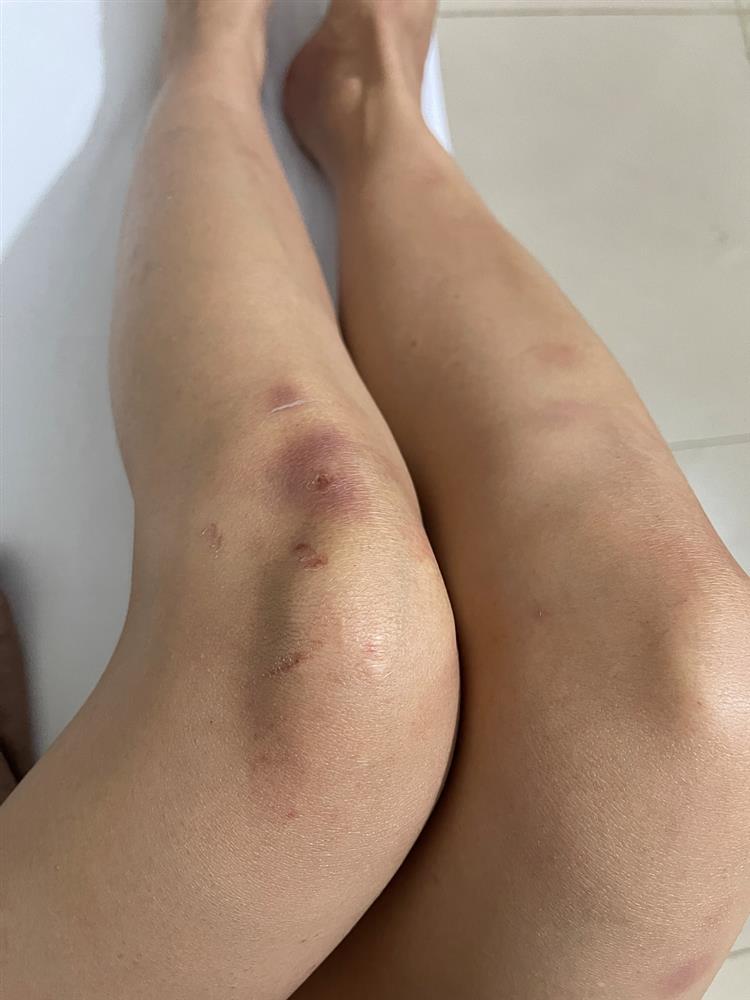 Thót tim cảnh Sam rơi xuống thác nước, mặt bị sưng phù-6