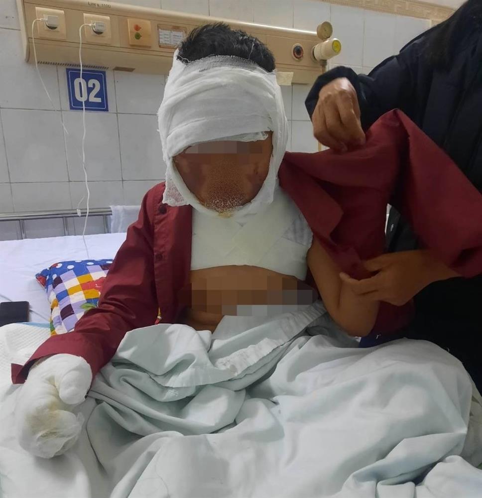 Clip: Nghịch dại đổ cồn vào lửa, bé trai bị bỏng nặng tới 30%-3