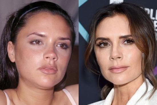 Victoria Beckham lên tiếng về tin đồn sửa mũi