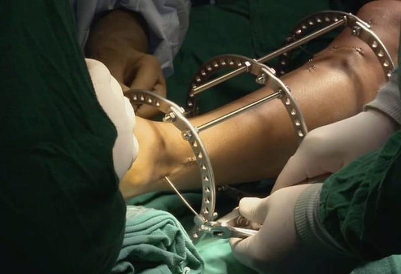 Ham kéo dài chân, cô gái 19 tuổi không thể đi lại được nữa-1