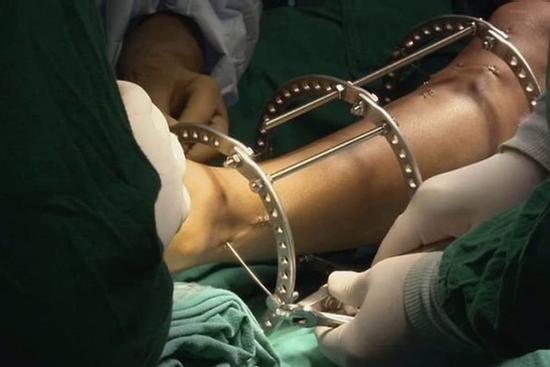 Ham kéo dài chân, cô gái 19 tuổi không thể đi lại được nữa