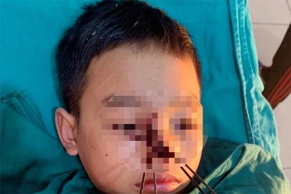 Dùng nỏ tự chế bắt chuột, bé trai bị 4 mũi tên sắt bắn vào mặt-1