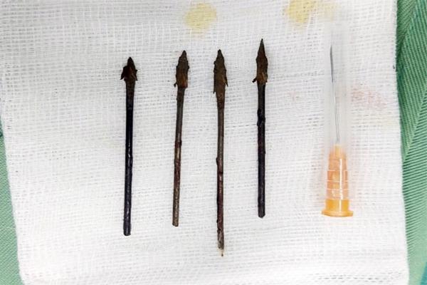 Dùng nỏ tự chế bắt chuột, bé trai bị 4 mũi tên sắt bắn vào mặt-2