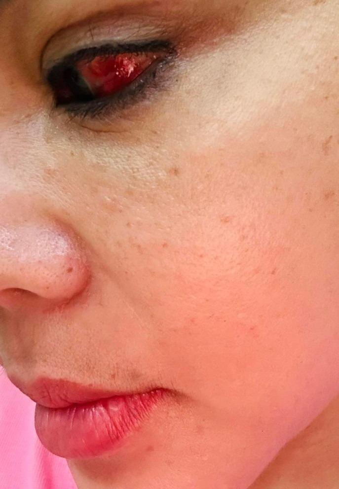 Nghệ sĩ Lê Giang rách giác mạc, tụ máu ở mắt do tai nạn-2