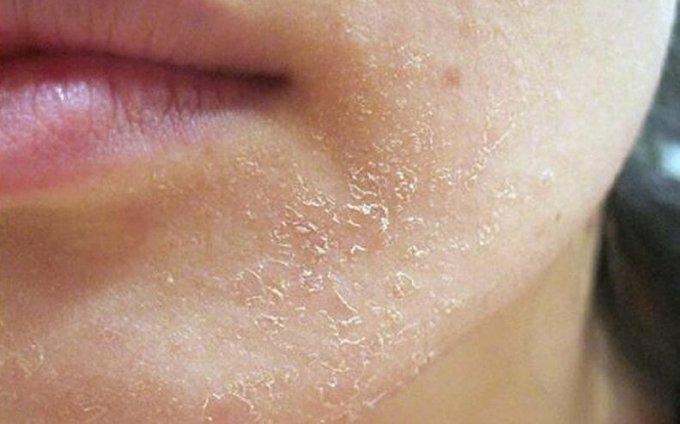 Ba nguyên tắc cơ bản giảm khô nẻ, bong tróc da-1