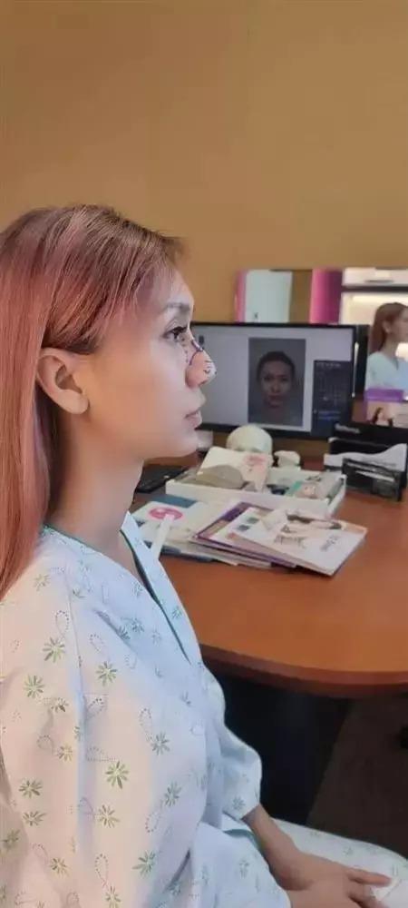 Chiếc mũi gây giật mình của Lynk Lee giờ ra sao sau 1 tháng dao kéo?-7