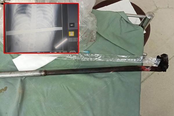 Cụ ông mắc lưỡi câu trong bụng nhiều ngày mới biết-3