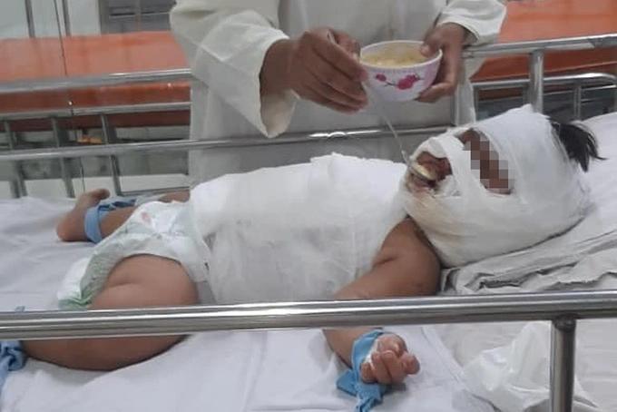 Ngã vào nồi nước sôi mẹ nấu, bé gái 1 tuổi bỏng thương tâm-1