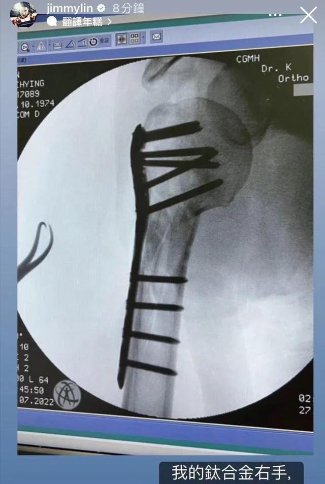 Lâm Chí Dĩnh phải đóng 10 chiếc đinh lớn vào tay phải-1