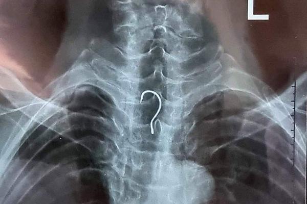 Cụ ông mắc lưỡi câu trong bụng nhiều ngày mới biết-1