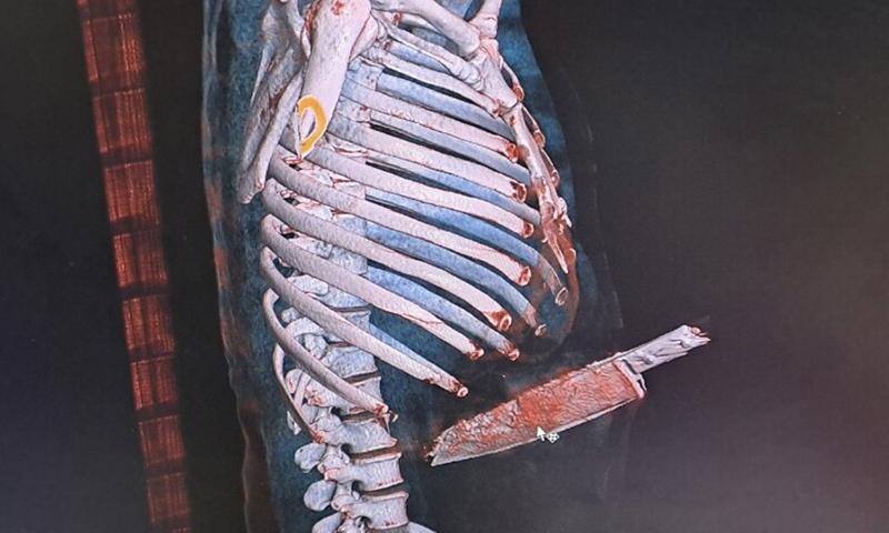 Cãi nhau trong lúc nhậu, thanh niên bị bạn cắm cây dao giữa bụng-1