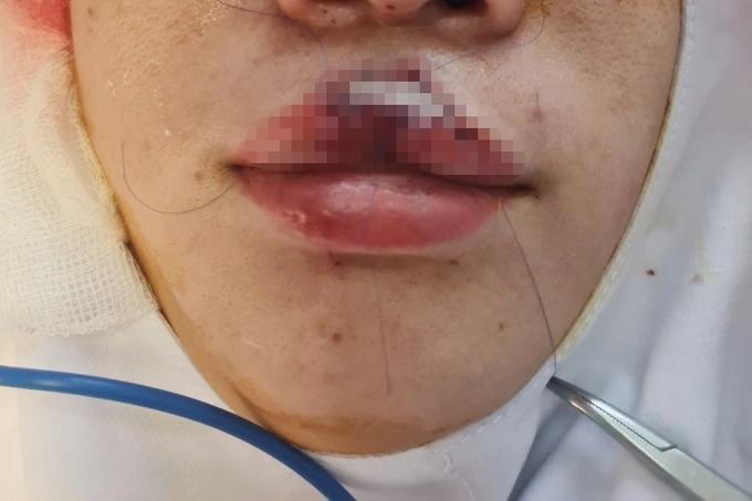 Vuốt ve chó đang ăn, cô gái bị cắn đứt môi-2