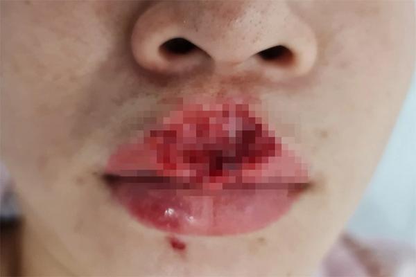 Thanh niên tử vong sau khi ăn thịt con chó cắn mình-2