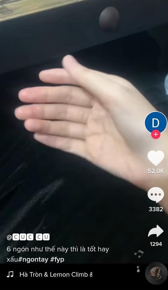 Xôn xao người có tay 6 ngón đều chằn chặn, họa hung cát ra sao?-3