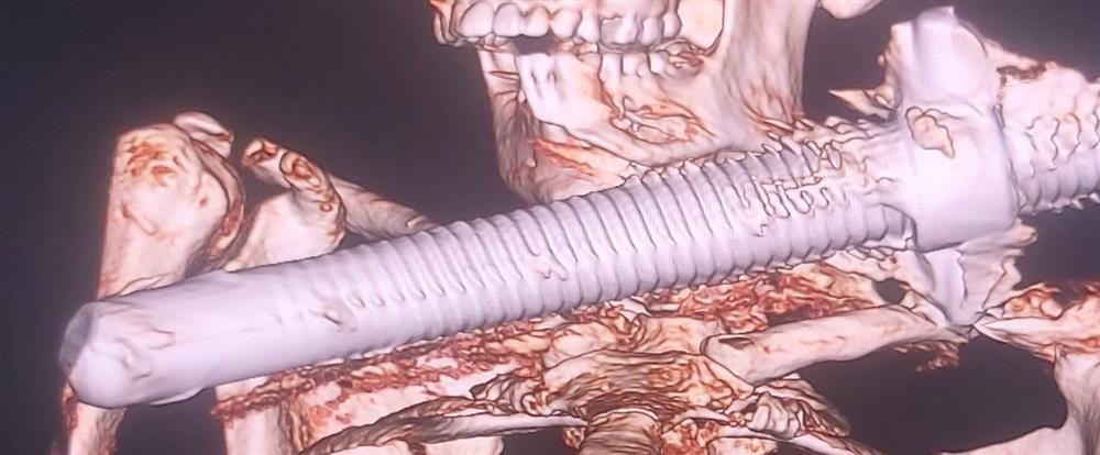 Công nhân ngã giàn giáo bị thanh sắt xuyên cổ nguy kịch-3