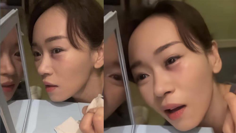 Hoa hậu Hong Kong Dương Tư Kỳ suýt bị mù-1