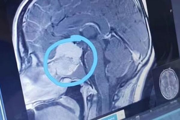 Phát hiện u não nhờ đi khám mắt định kỳ-1